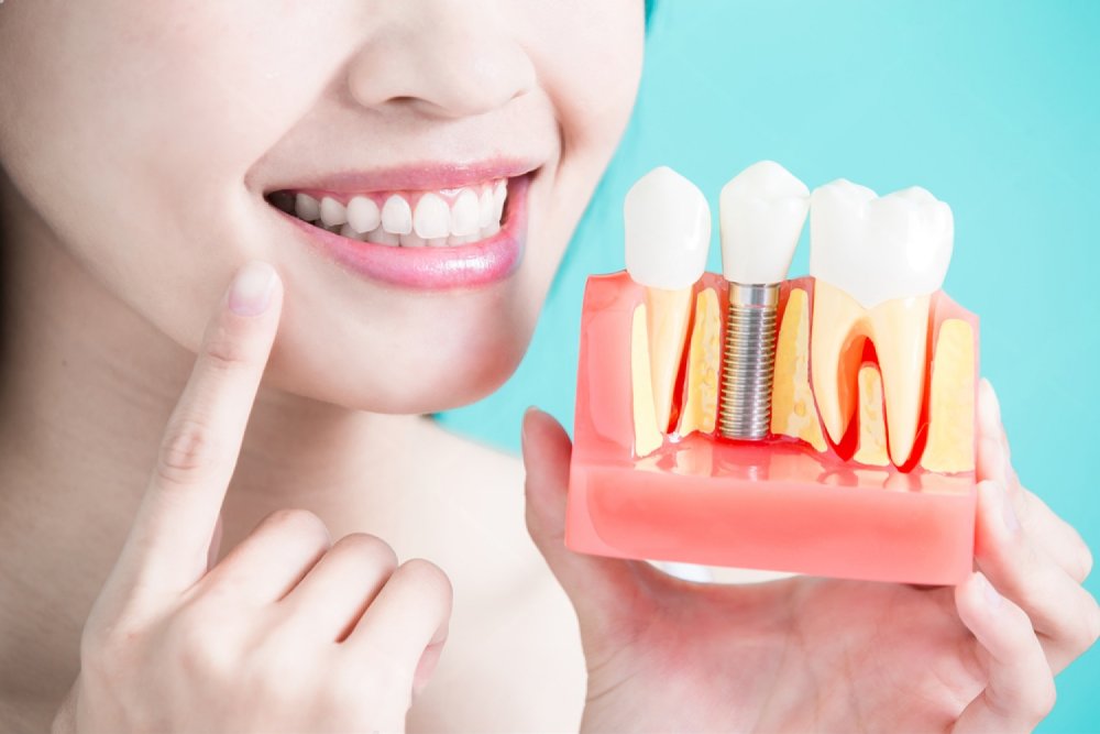 Implantul dentar: Redescoperă bucuria de a mesteca și de a zâmbi fără rețineri